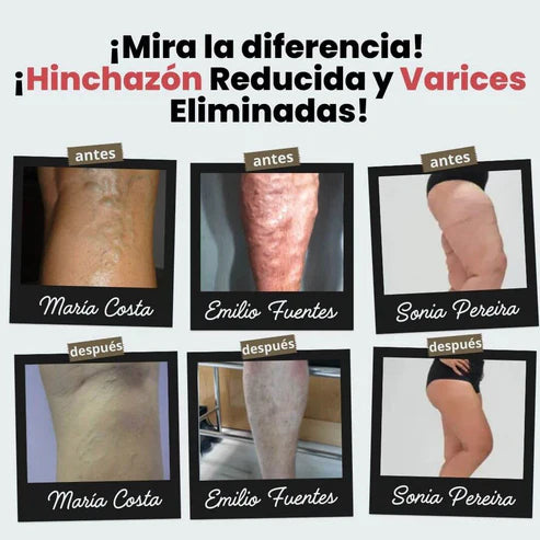 Elimina las Varices con los Calcetines CALVIX (OFERTA 2x1)